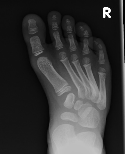 Skewfoot