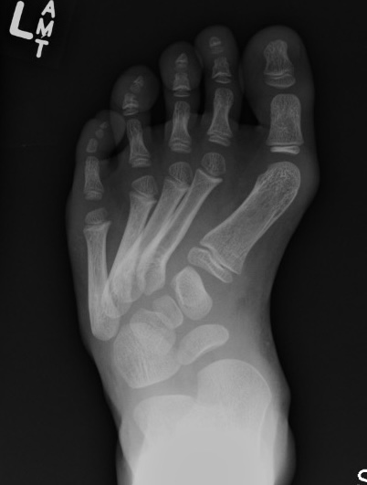 Skewfoot