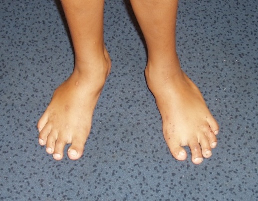 Skewfoot