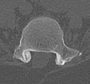 Spina bifida
