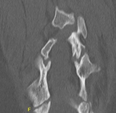 Spina bifida