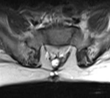 Spina bifida