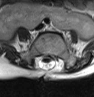 Spina bifida