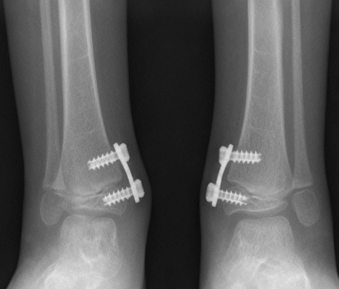 Planovalgus spina bifida