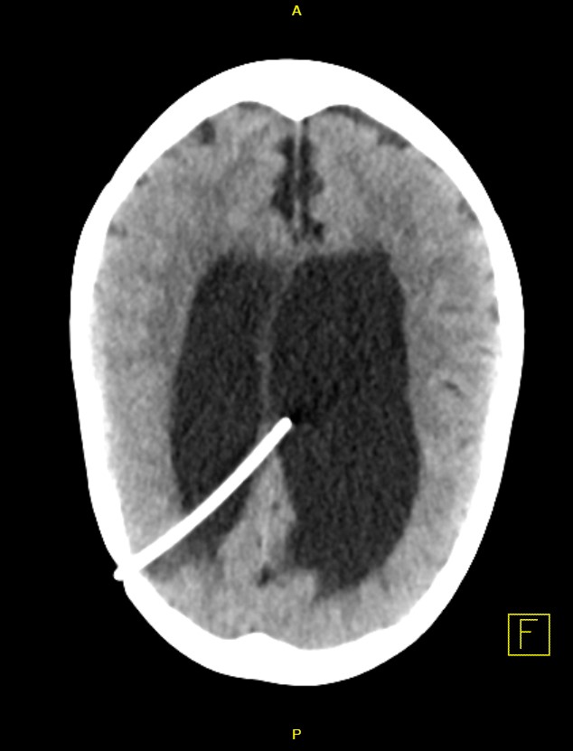 Hydrocephalus