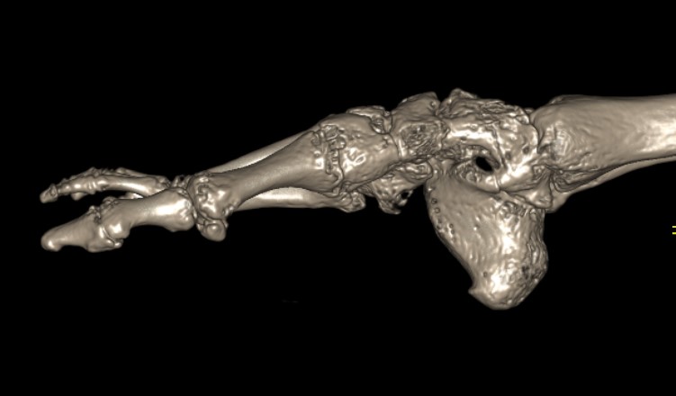 Spina bifida 