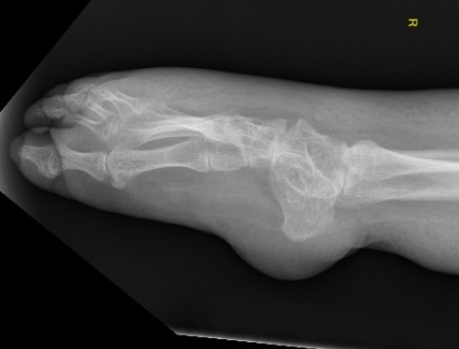 Spina bifida 