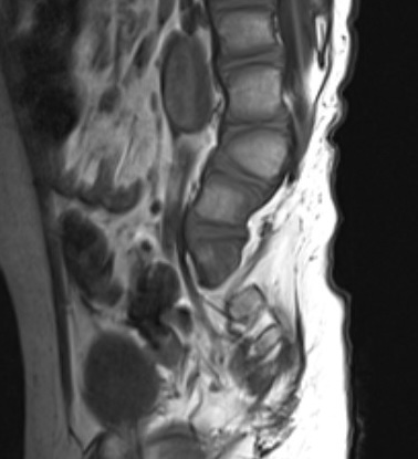 Spina bifida