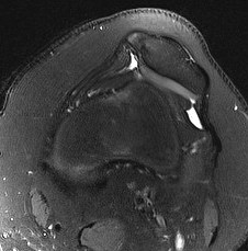 patella