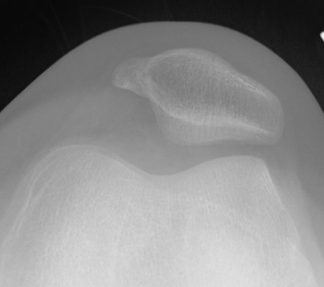 patella