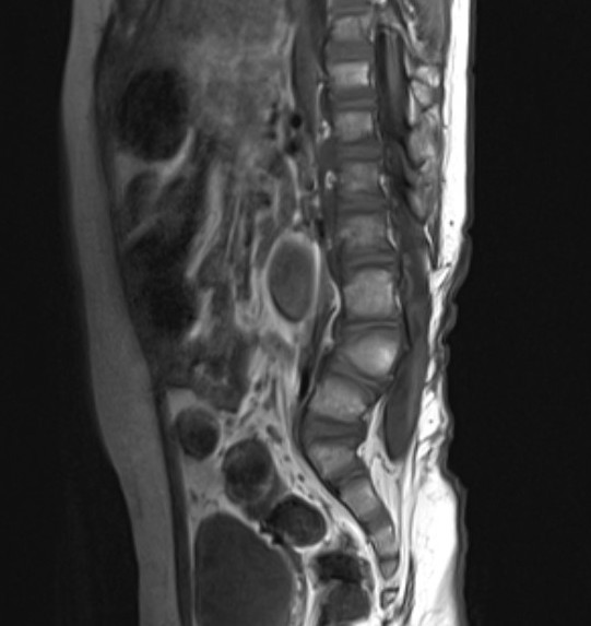 Spina bifida