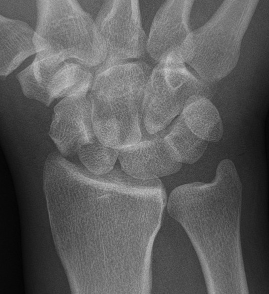 Transscaphoid