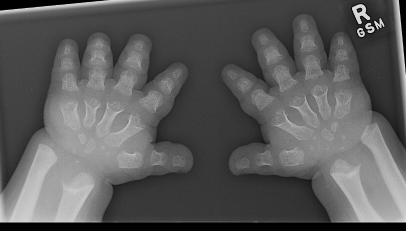 Achondroplasia