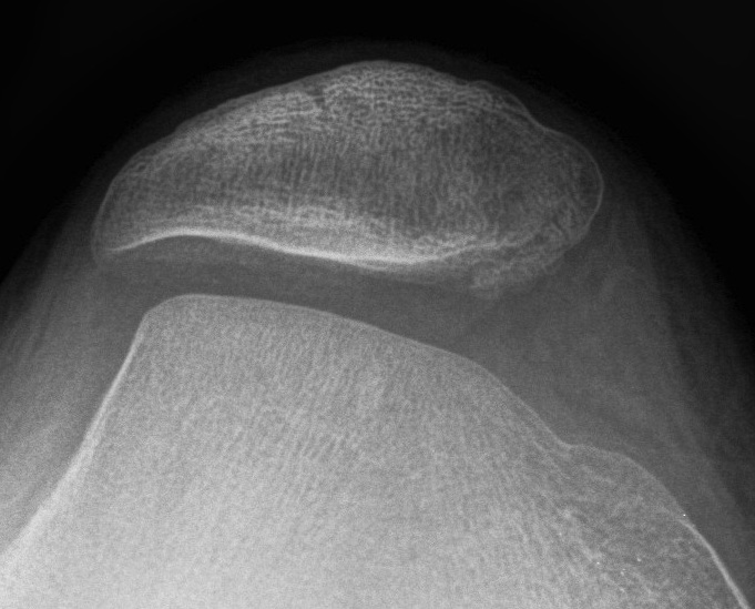 Trochlea dysplasia