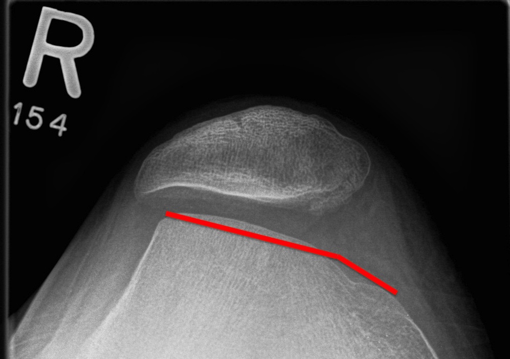 dysplasia