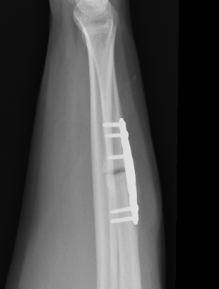 nonunion