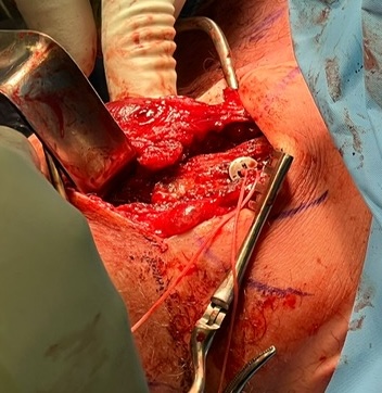 ACJ reconstruction