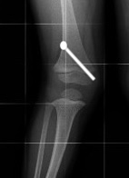 Percutaneous screw