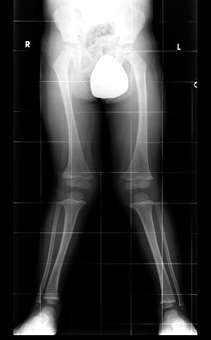 valgus