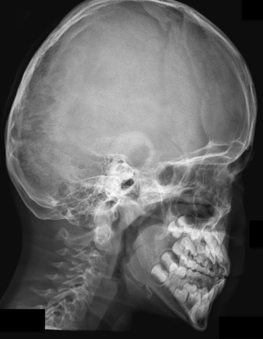 OI skull