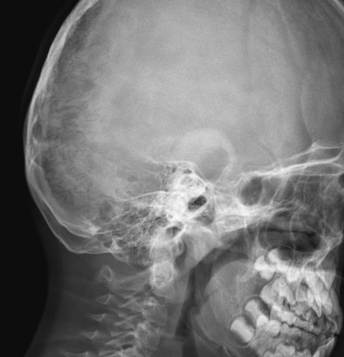 OI skull