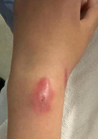 Infection