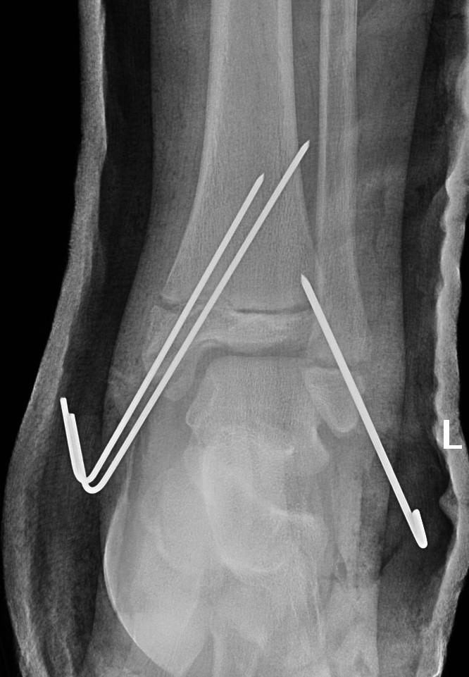 ankle frac