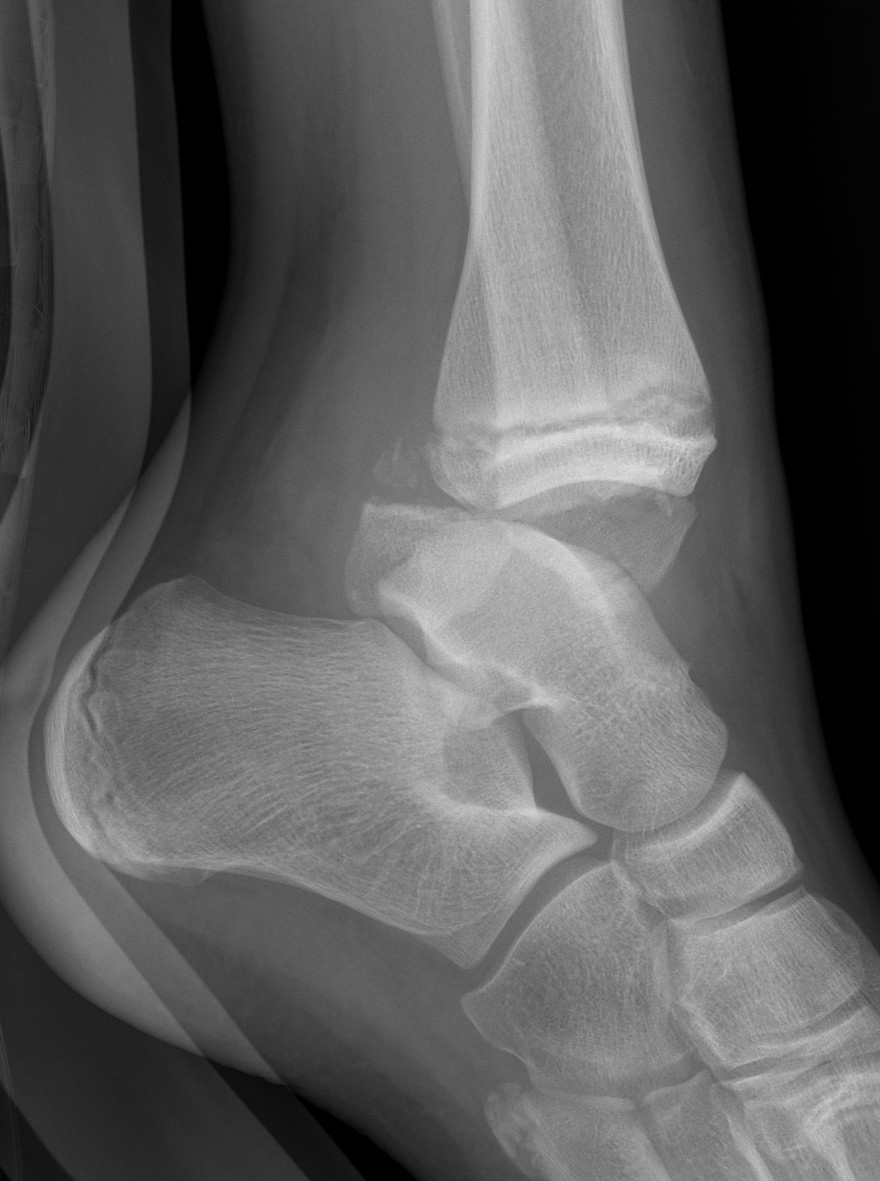 ankle frac