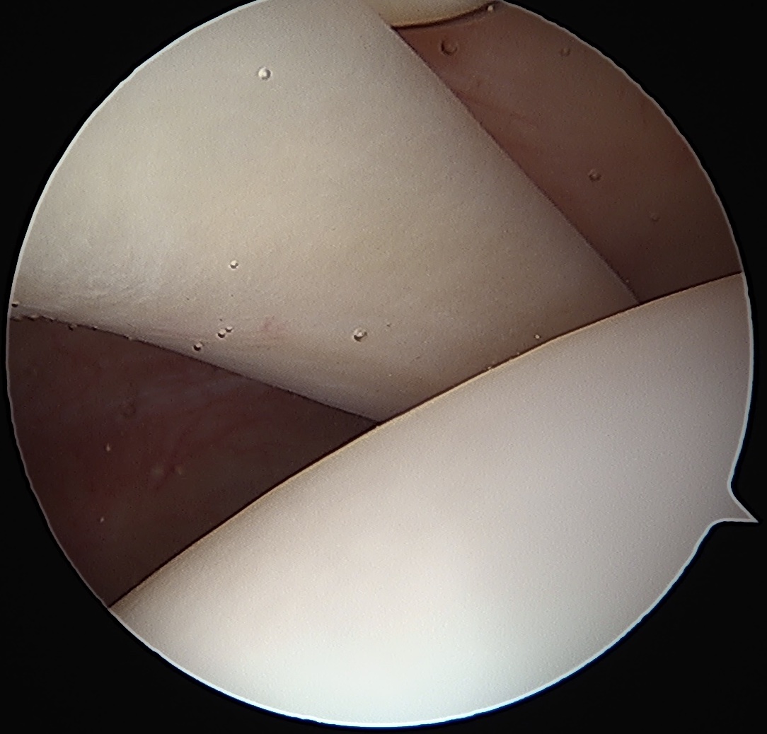 LBH tendinopathy