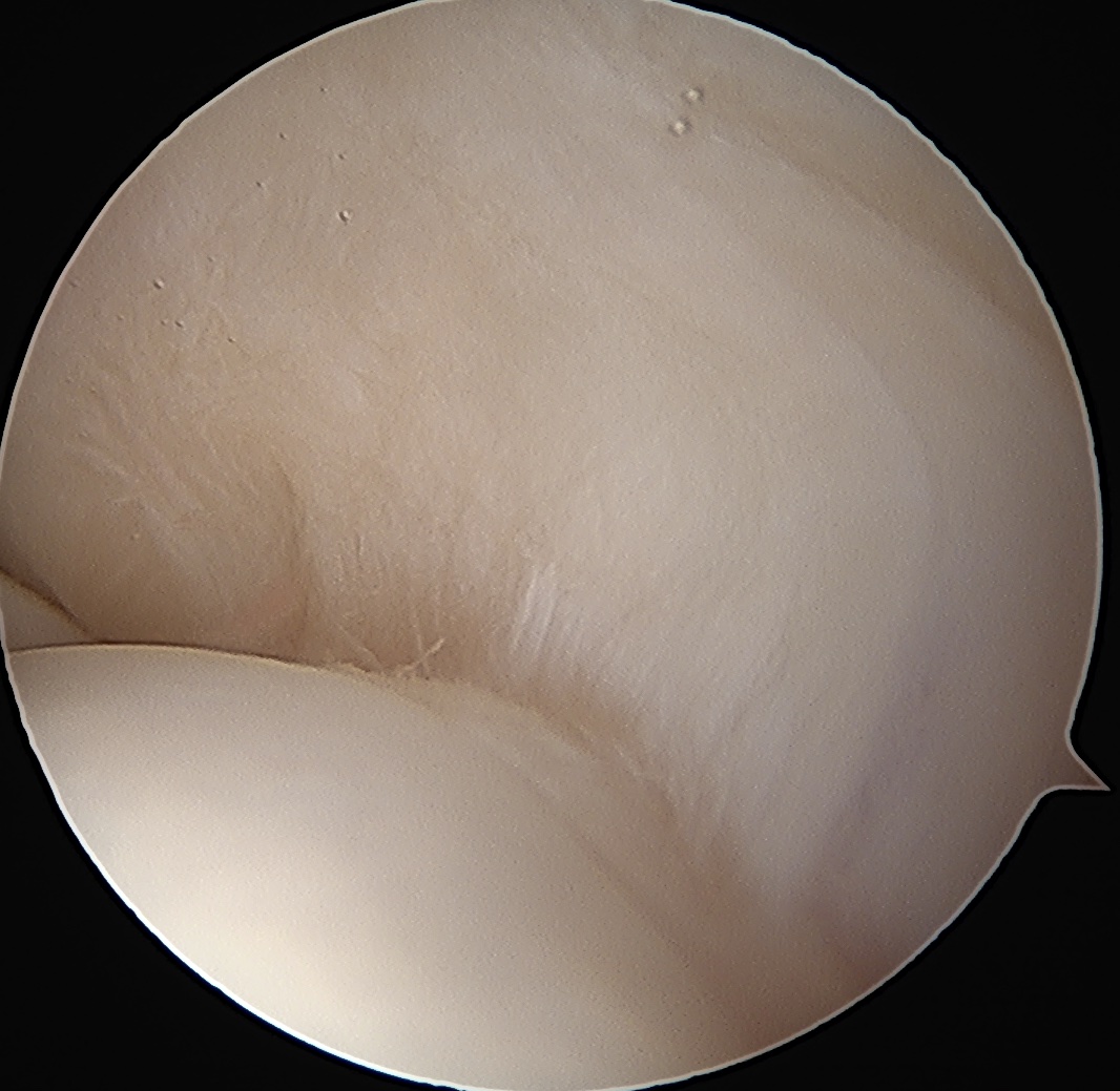 normal cuff
