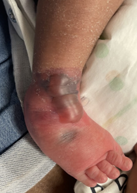 CTEV blisters