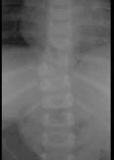 congenital scoliosis