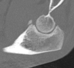 coronoid