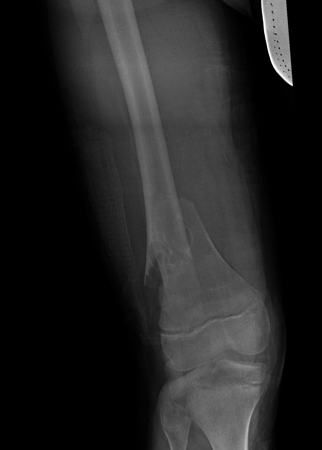 dis femur