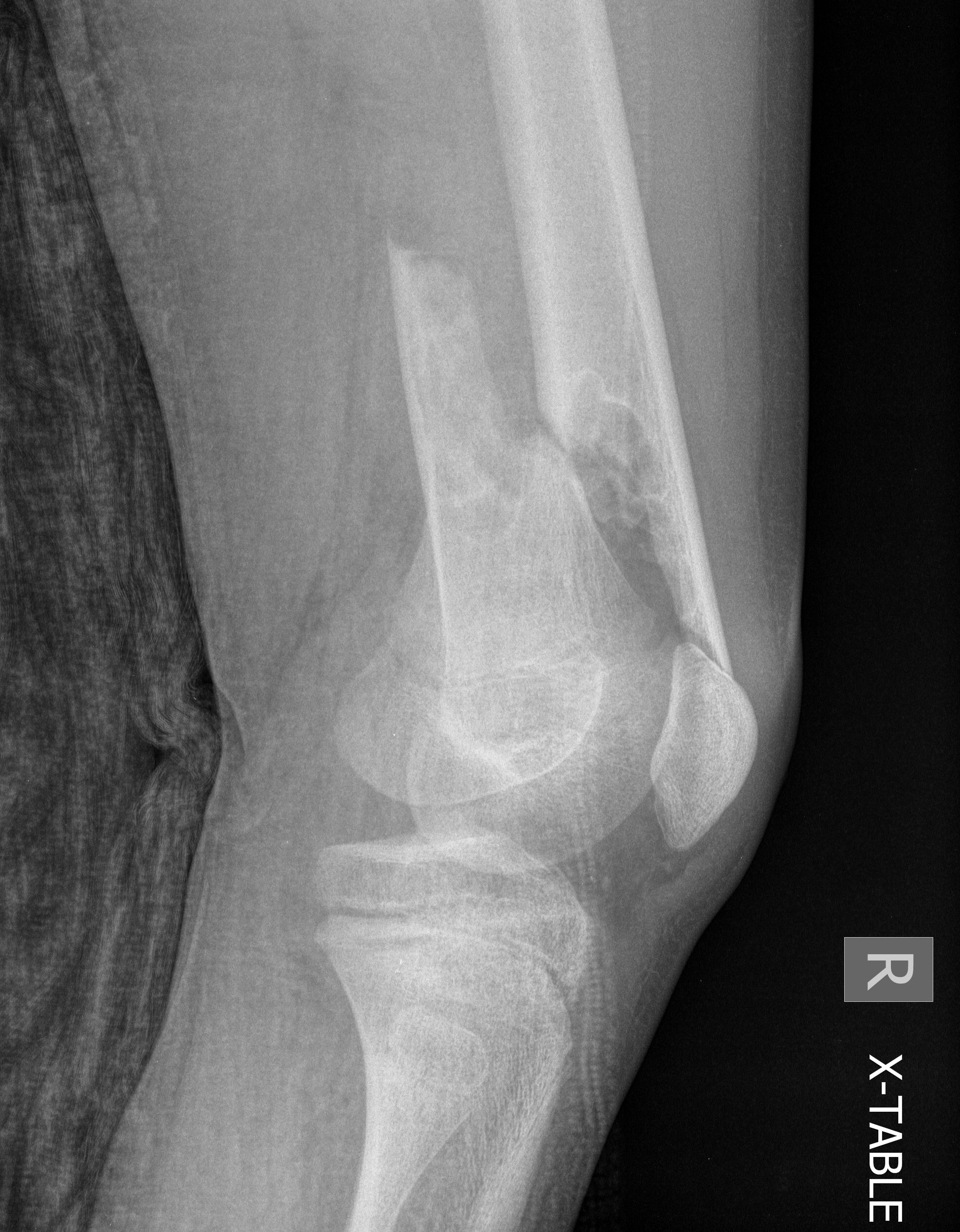 dis femur