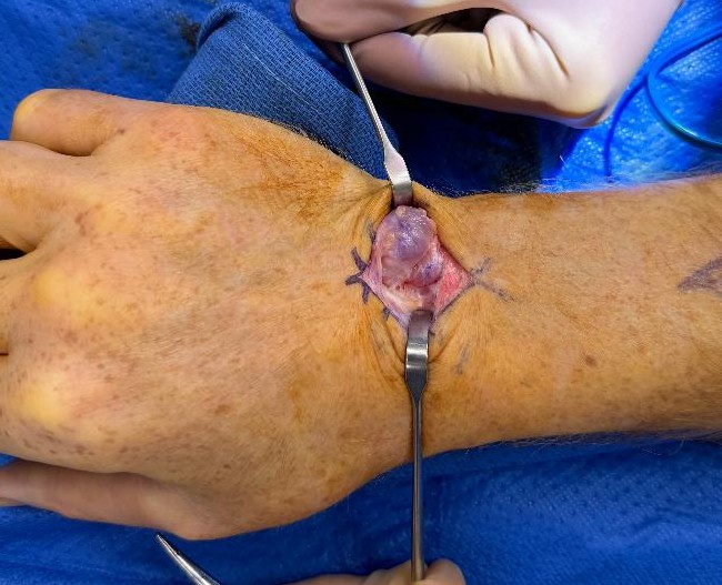 dorsal ganglion