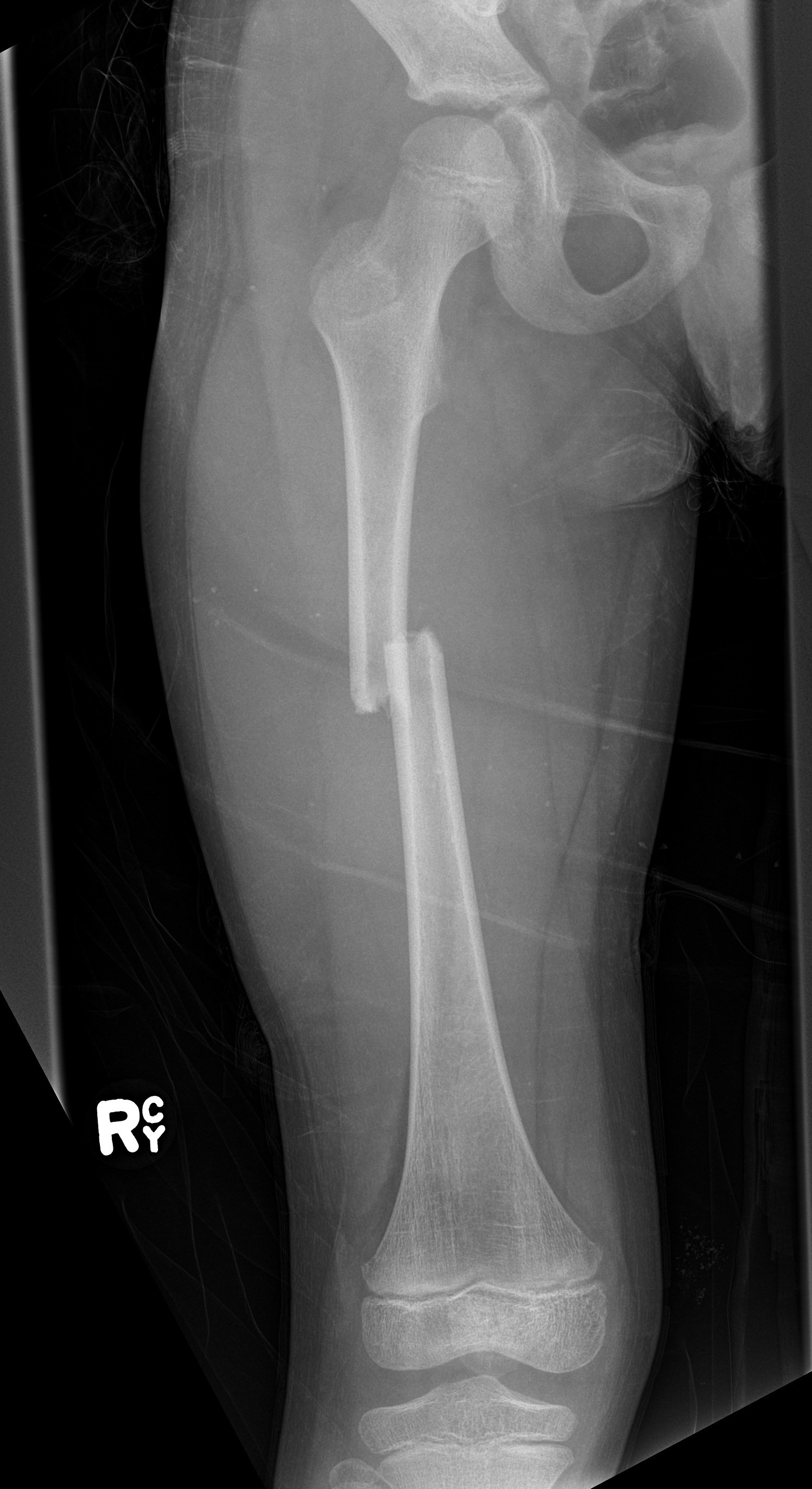 femur