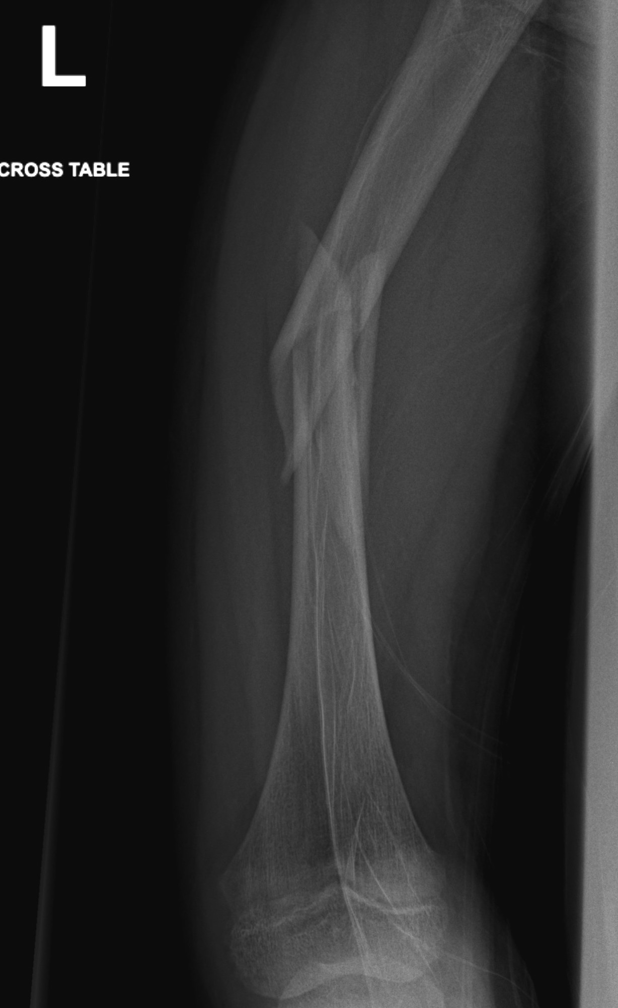 femur plate