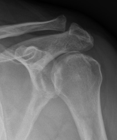 glenoid