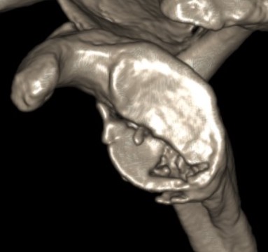 glenoid