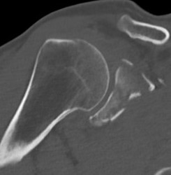 Glenoid