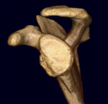 Bony bankart