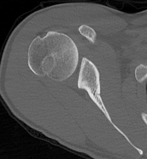 glenoid retro
