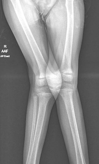 valgus malalignment