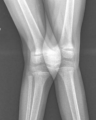 rickets guided growth