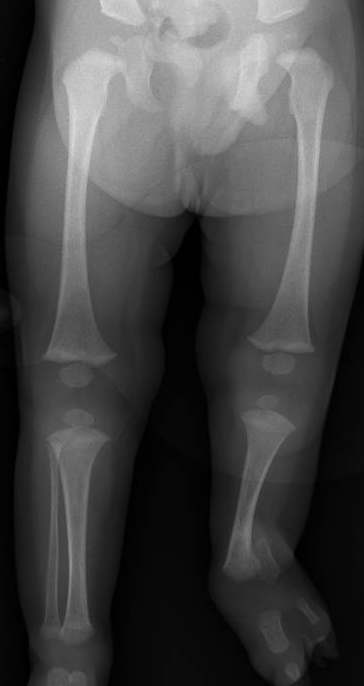 fibular hemimelia
