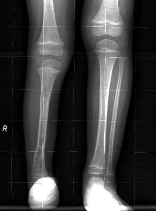 Fibular hemimelia