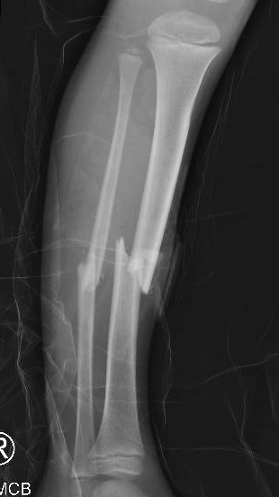 Tibial tens