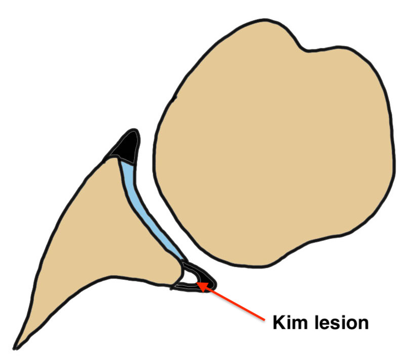 Kim lesion