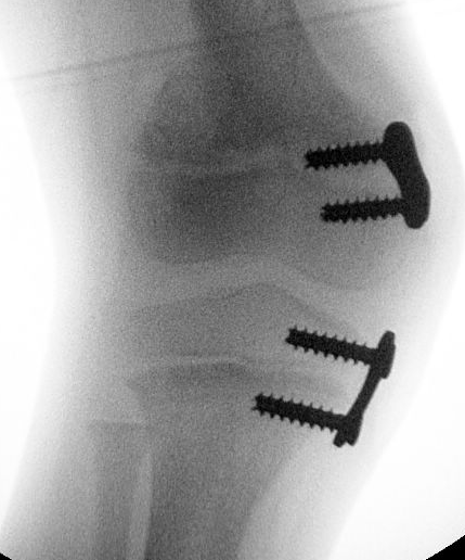 rickets guided growth